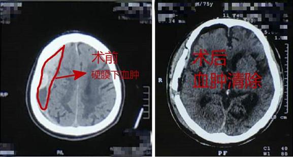 意外磕到頭不重視 當心出大問題