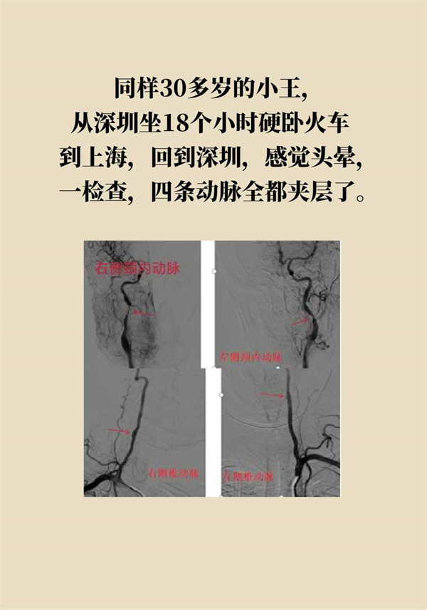 這個動作讓多名年輕人中風了，一定要重視！