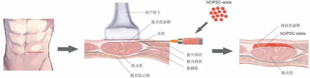 事關(guān)糖尿病治療，我國科學(xué)家取得突破